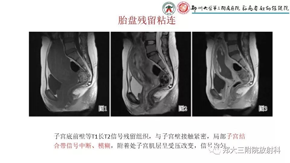 【PPT】产后胎盘残留的影像表现
