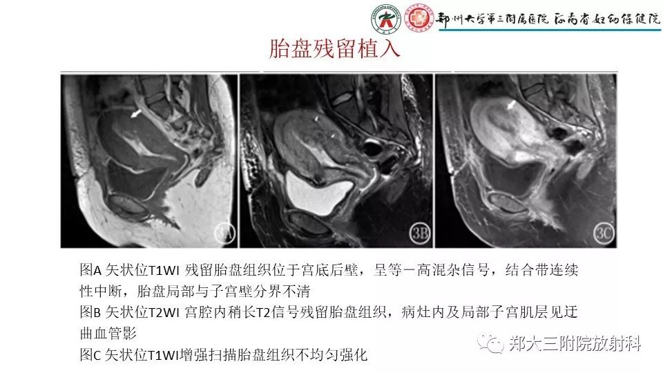 【PPT】产后胎盘残留的影像表现