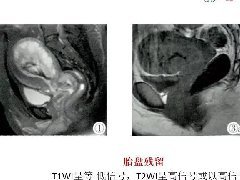 产后胎盘残留的影像表现