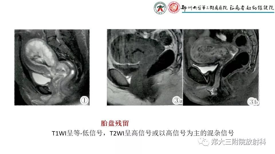 【PPT】产后胎盘残留的影像表现