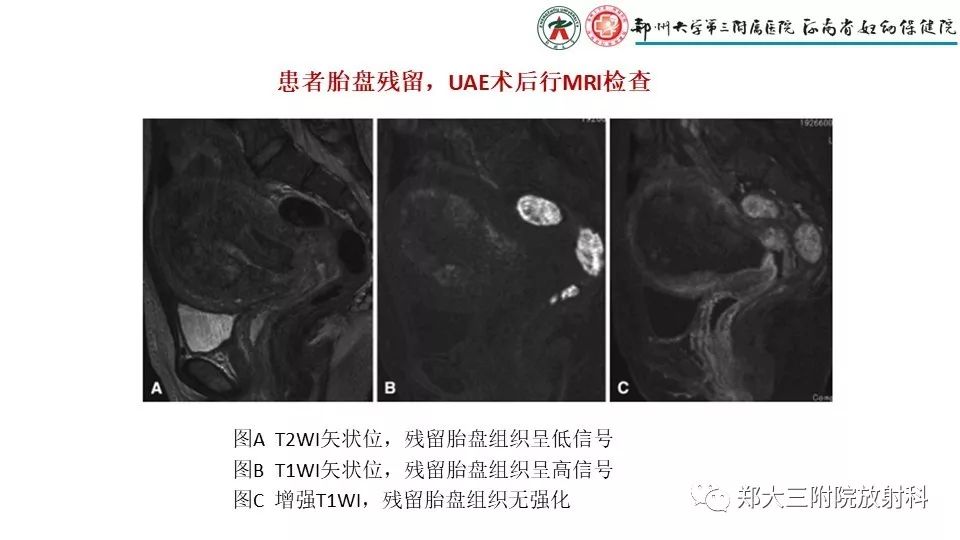 【PPT】产后胎盘残留的影像表现