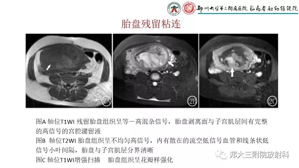 【PPT】产后胎盘残留的影像表现