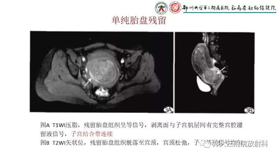 【PPT】产后胎盘残留的影像表现