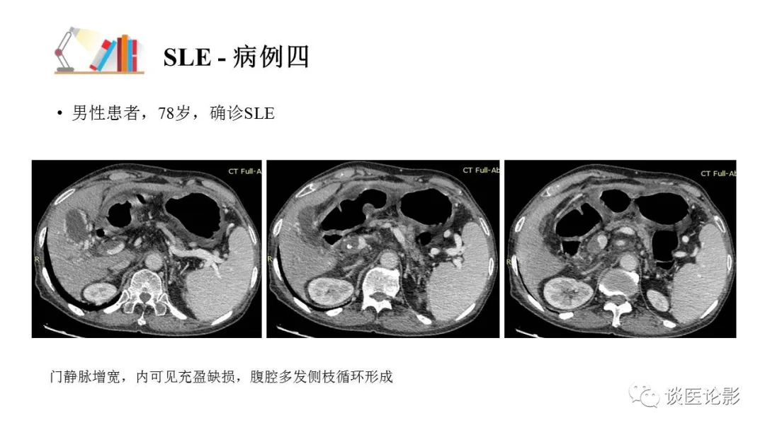 【PPT】 系统性红斑狼疮（SLE）的腹部影像表现