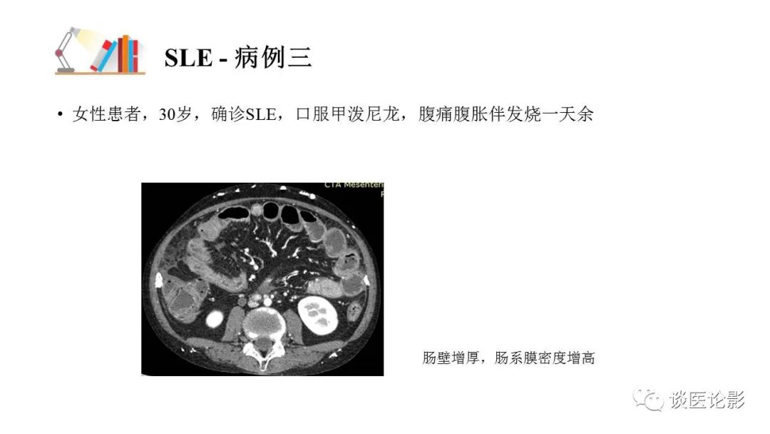 【PPT】 系统性红斑狼疮（SLE）的腹部影像表现