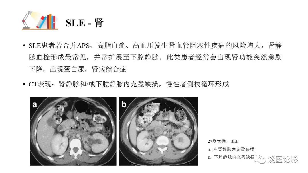 【PPT】 系统性红斑狼疮（SLE）的腹部影像表现