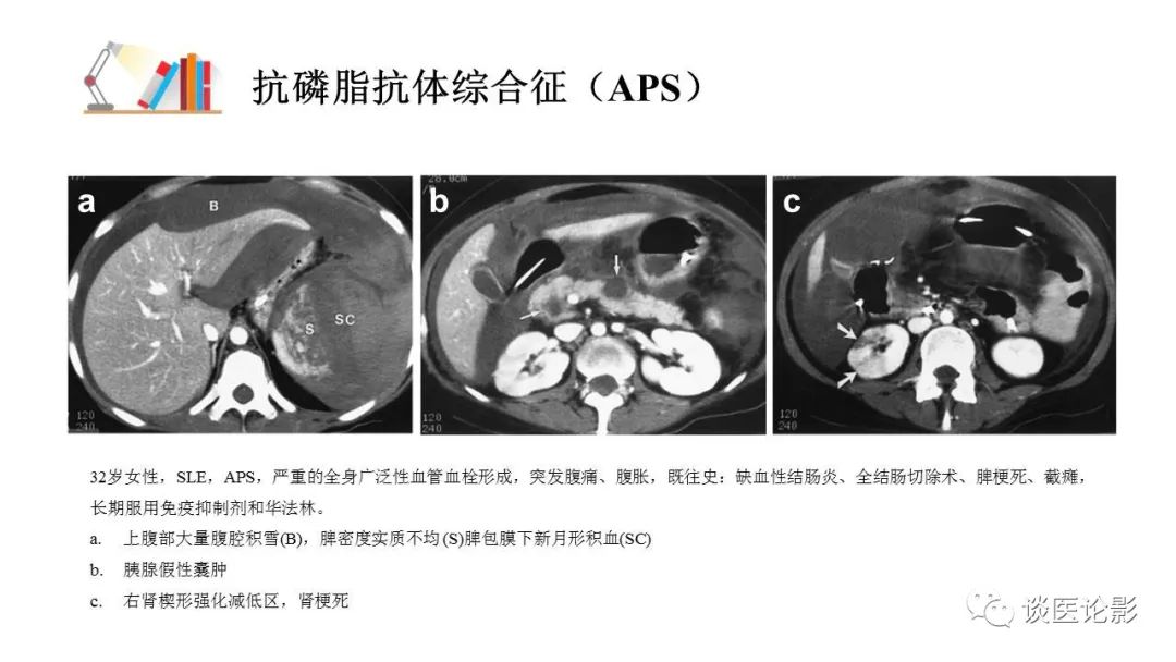 【PPT】 系统性红斑狼疮（SLE）的腹部影像表现