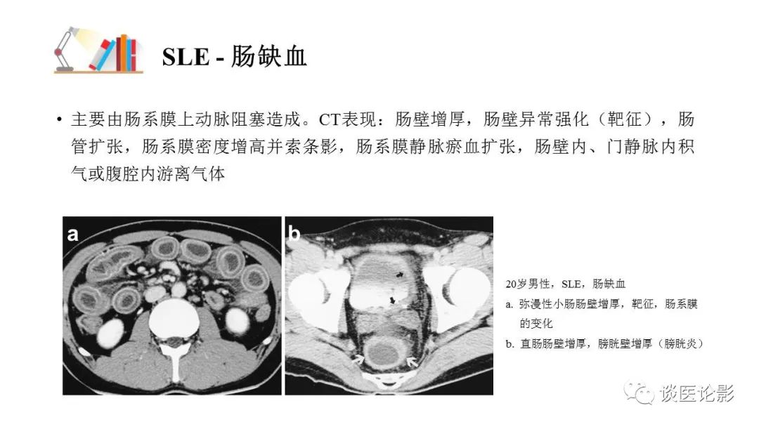 【PPT】 系统性红斑狼疮（SLE）的腹部影像表现