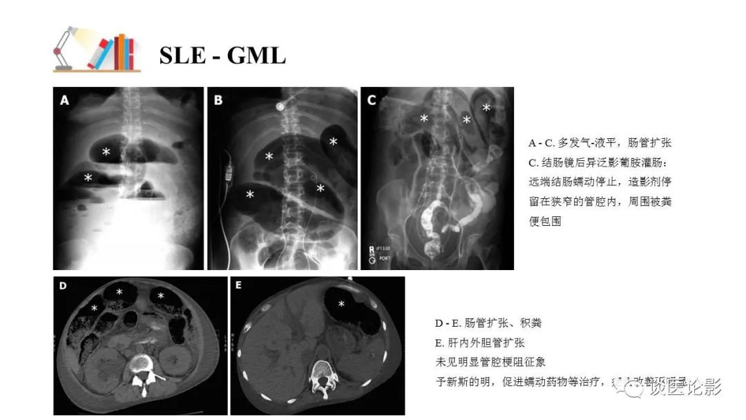 【PPT】 系统性红斑狼疮（SLE）的腹部影像表现