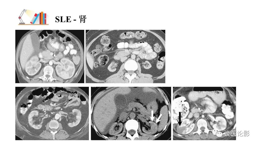 【PPT】 系统性红斑狼疮（SLE）的腹部影像表现