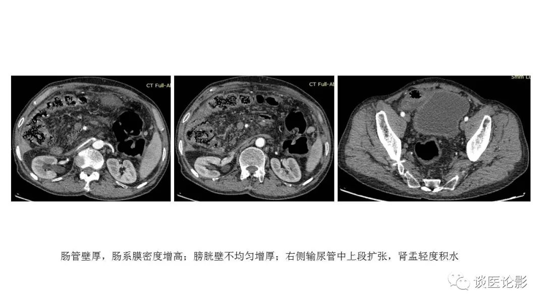 【PPT】 系统性红斑狼疮（SLE）的腹部影像表现