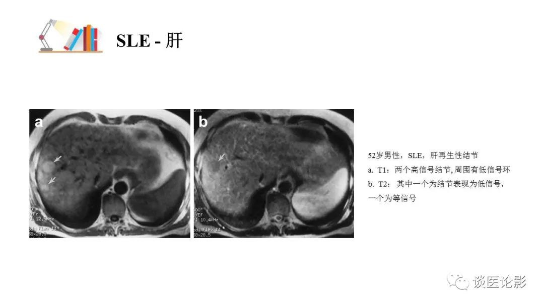 【PPT】 系统性红斑狼疮（SLE）的腹部影像表现