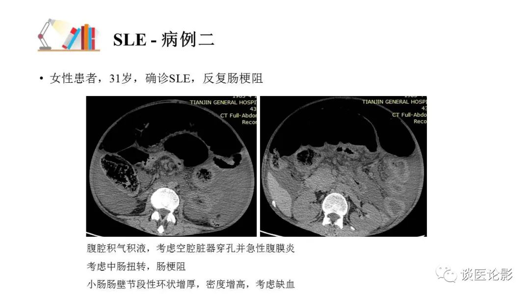 【PPT】 系统性红斑狼疮（SLE）的腹部影像表现