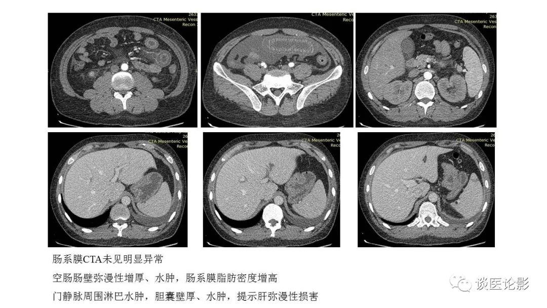 【PPT】 系统性红斑狼疮（SLE）的腹部影像表现