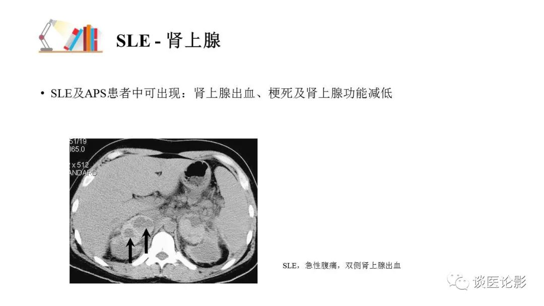 【PPT】 系统性红斑狼疮（SLE）的腹部影像表现