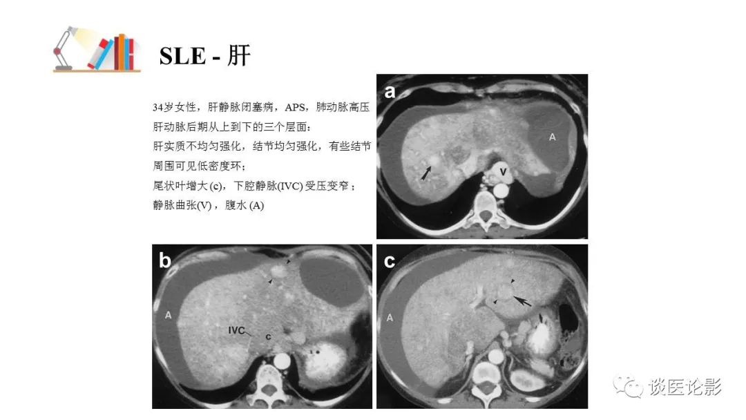 【PPT】 系统性红斑狼疮（SLE）的腹部影像表现