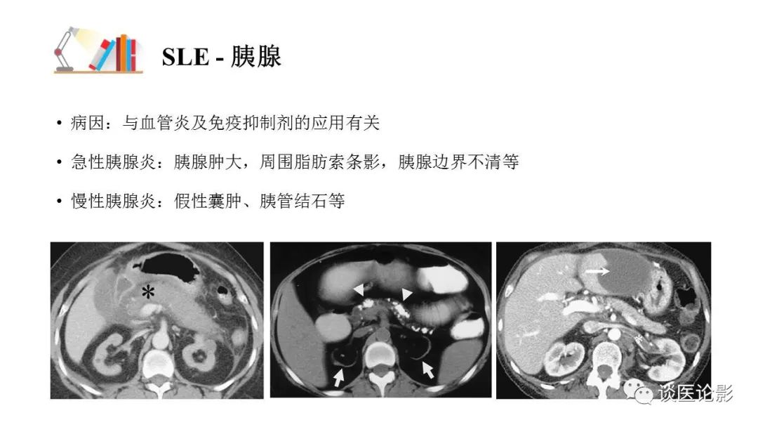 【PPT】 系统性红斑狼疮（SLE）的腹部影像表现