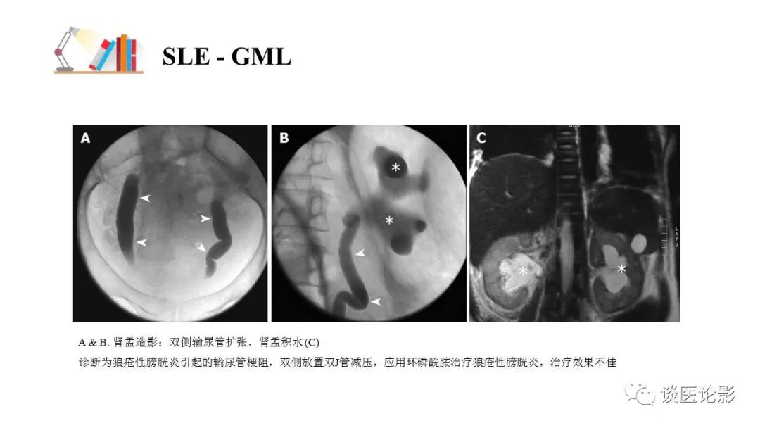 【PPT】 系统性红斑狼疮（SLE）的腹部影像表现