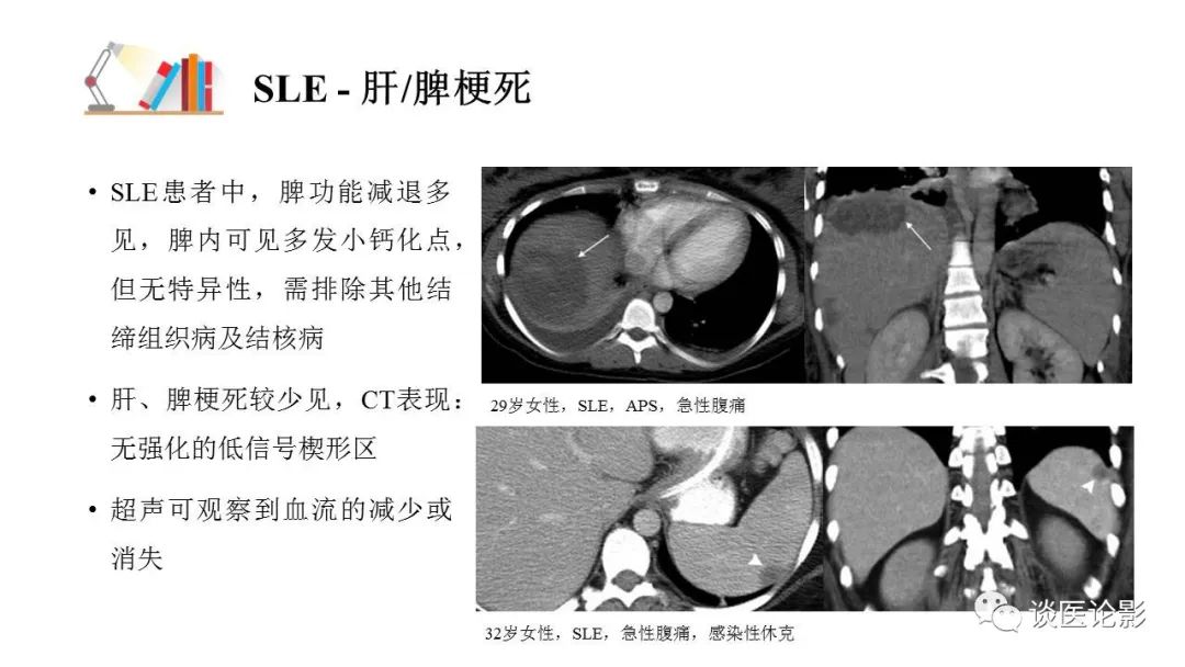 【PPT】 系统性红斑狼疮（SLE）的腹部影像表现