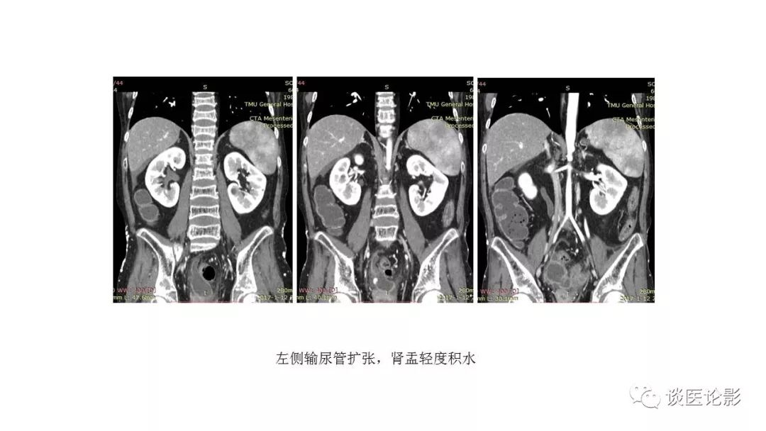 【PPT】 系统性红斑狼疮（SLE）的腹部影像表现