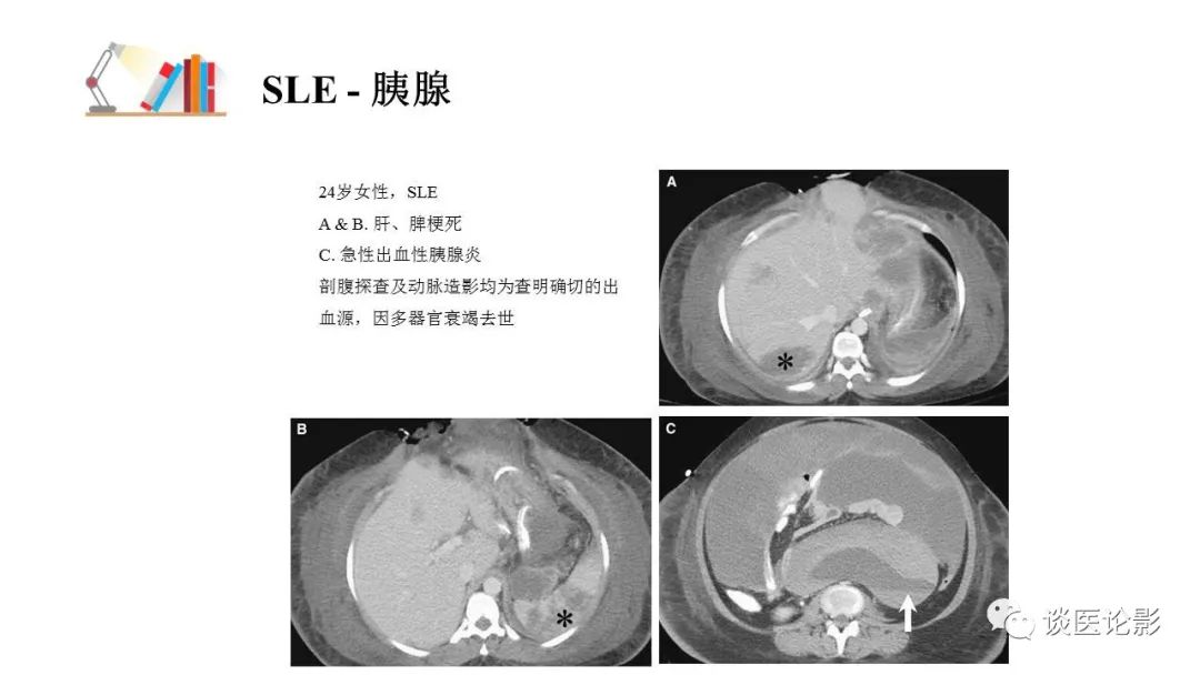 【PPT】 系统性红斑狼疮（SLE）的腹部影像表现