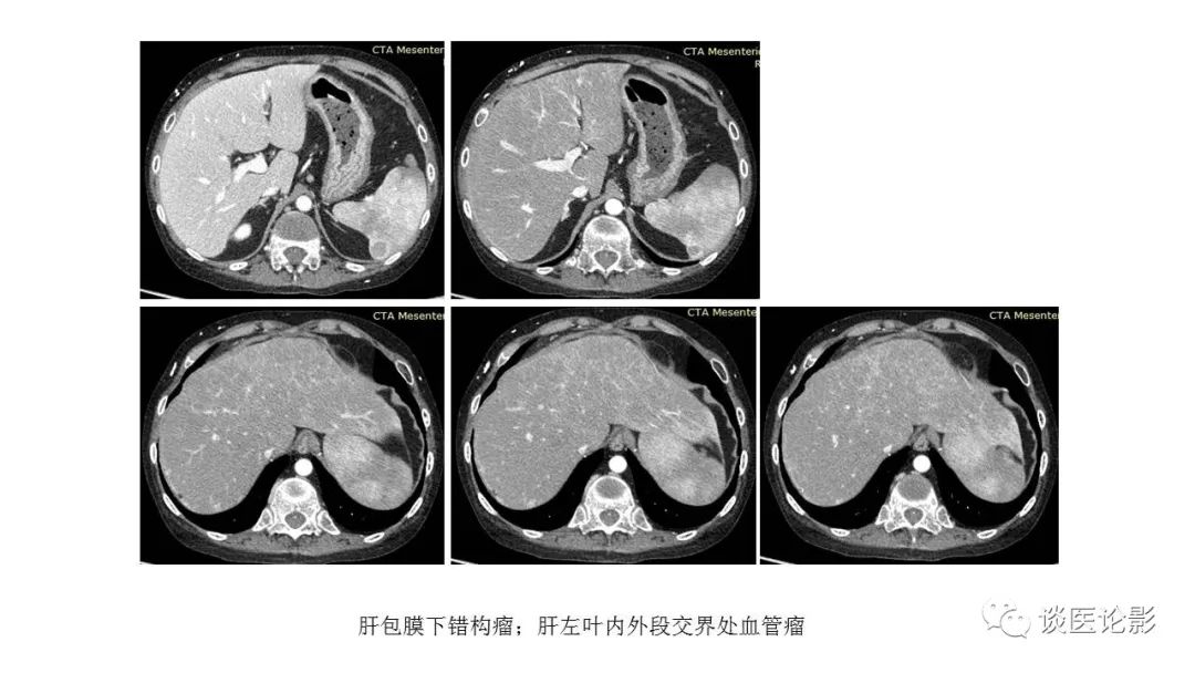 【PPT】 系统性红斑狼疮（SLE）的腹部影像表现