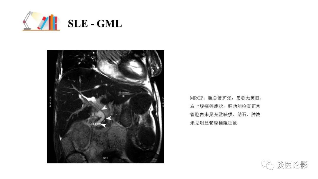 【PPT】 系统性红斑狼疮（SLE）的腹部影像表现