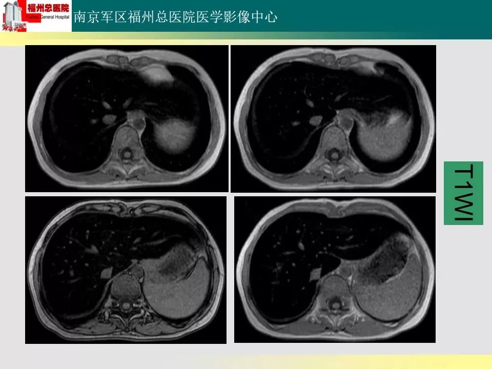 【PPT】肝血色病影像表现及鉴别诊断