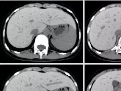 肝血色病1例CT及MR影像表现及鉴别诊断
