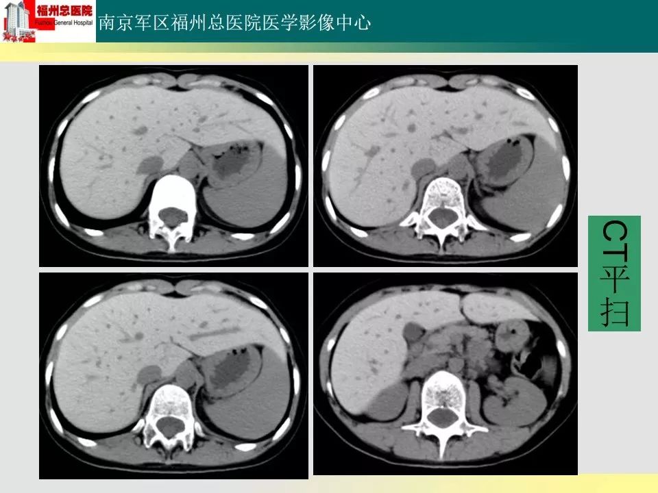 【PPT】肝血色病影像表现及鉴别诊断