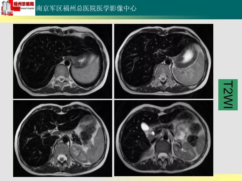 【PPT】肝血色病影像表现及鉴别诊断