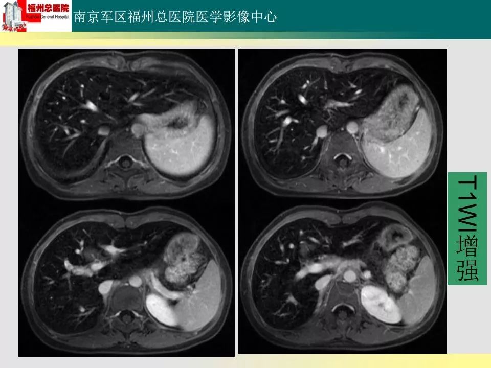 【PPT】肝血色病影像表现及鉴别诊断