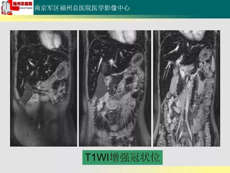 【PPT】肝血色病影像表现及鉴别诊断