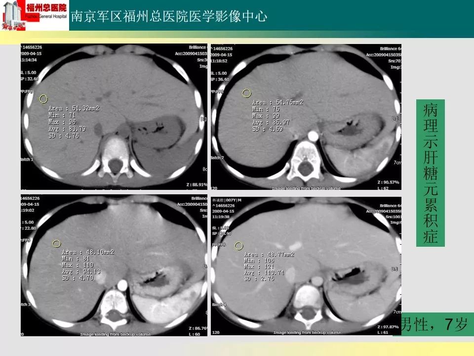 【PPT】肝血色病影像表现及鉴别诊断