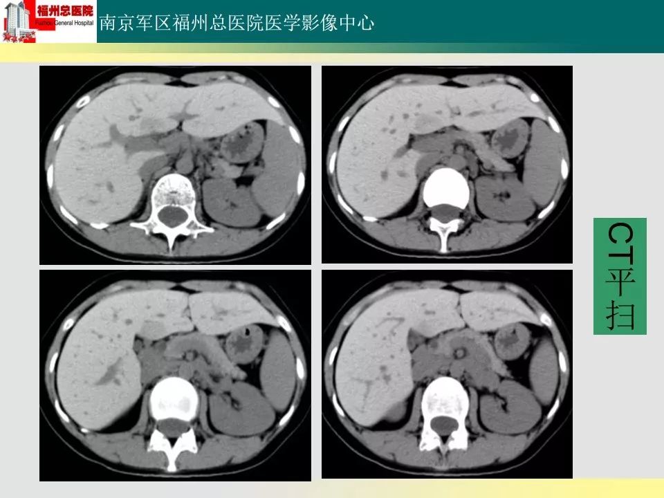 【PPT】肝血色病影像表现及鉴别诊断