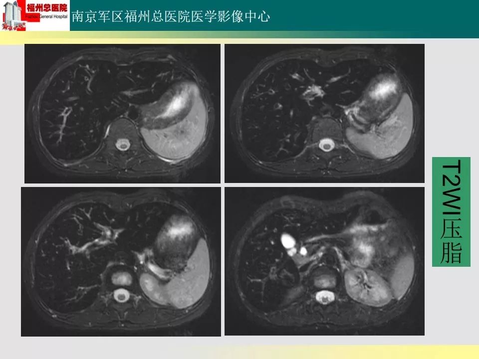 【PPT】肝血色病影像表现及鉴别诊断