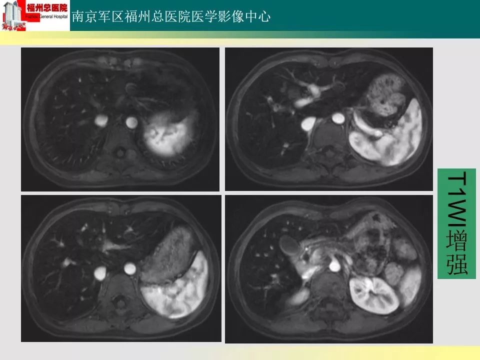 【PPT】肝血色病影像表现及鉴别诊断