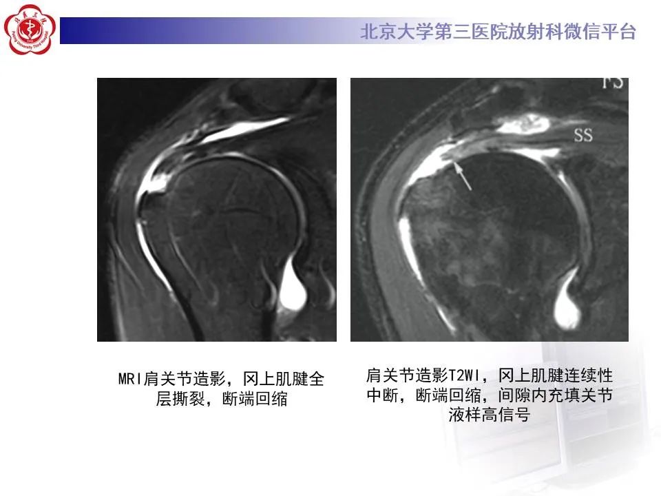 【PPT】慢性肩袖巨大撕裂的MR诊断