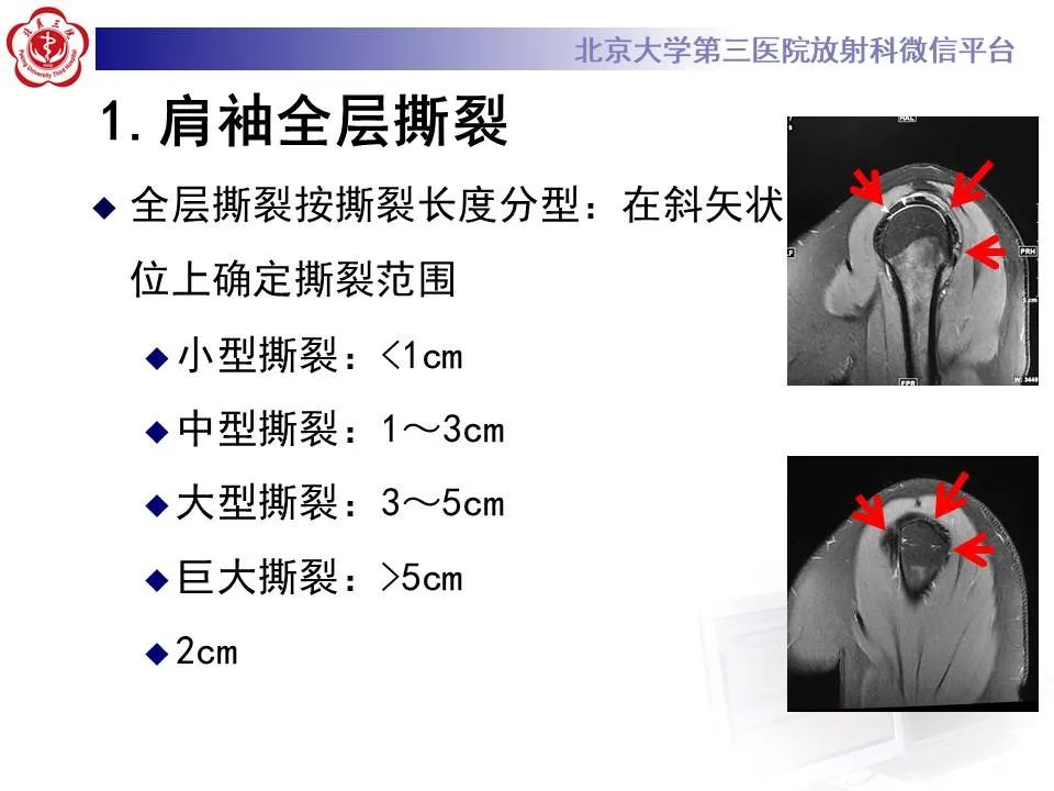 【PPT】慢性肩袖巨大撕裂的MR诊断