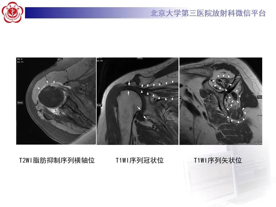 【PPT】慢性肩袖巨大撕裂的MR诊断