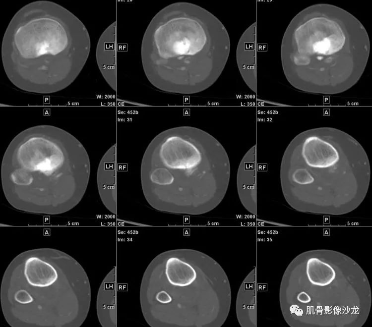 【病例】胫骨骨肉瘤1例CT影像