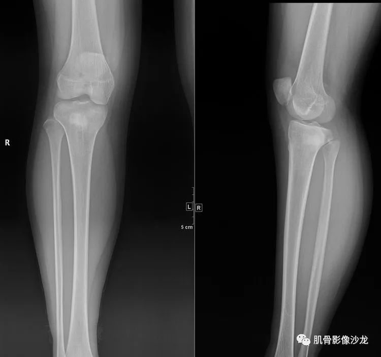 【病例】胫骨骨肉瘤1例CT影像