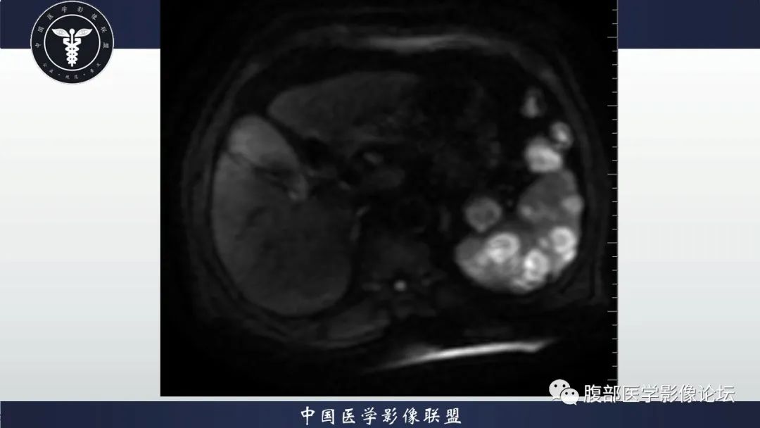 【病例】脾脏弥漫性大B细胞淋巴瘤1例MR影像讨论