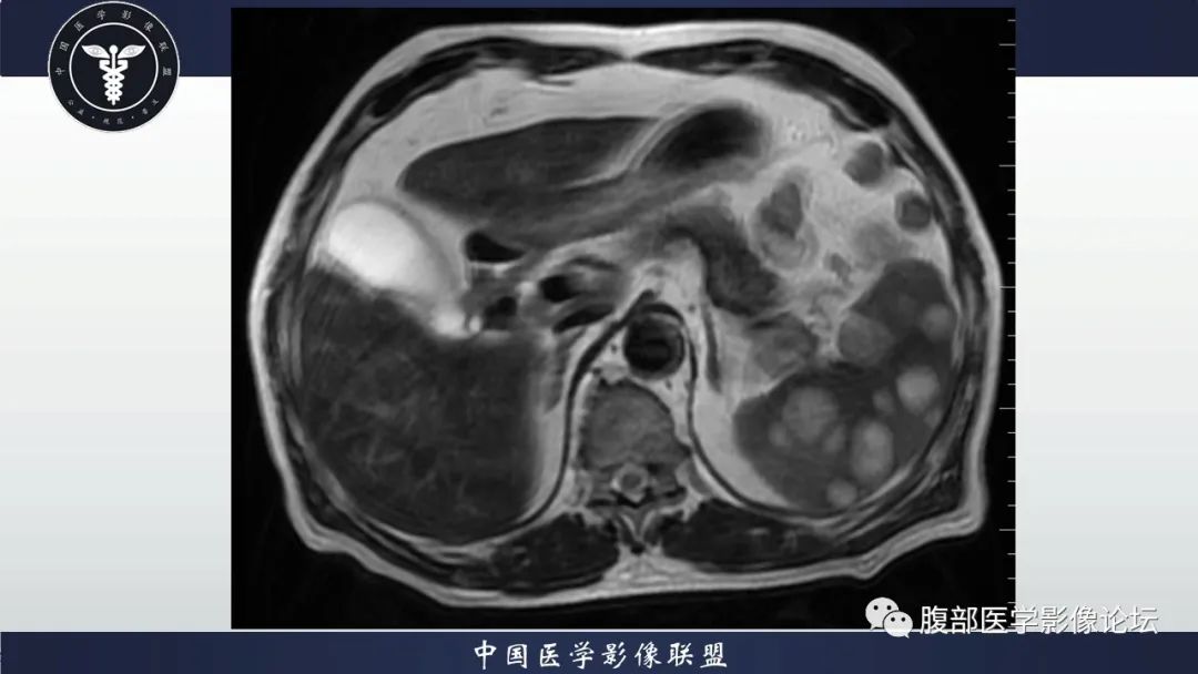 【病例】脾脏弥漫性大B细胞淋巴瘤1例MR影像讨论