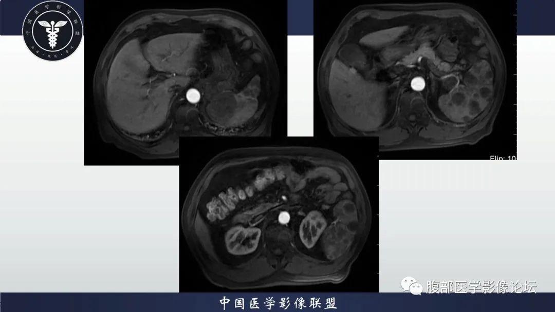 【病例】脾脏弥漫性大B细胞淋巴瘤1例MR影像讨论