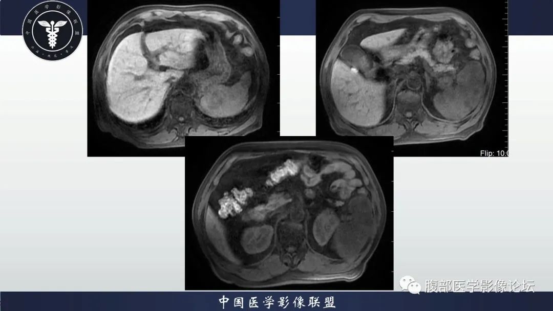 【病例】脾脏弥漫性大B细胞淋巴瘤1例MR影像讨论