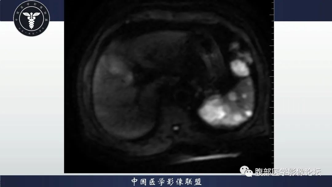 【病例】脾脏弥漫性大B细胞淋巴瘤1例MR影像讨论