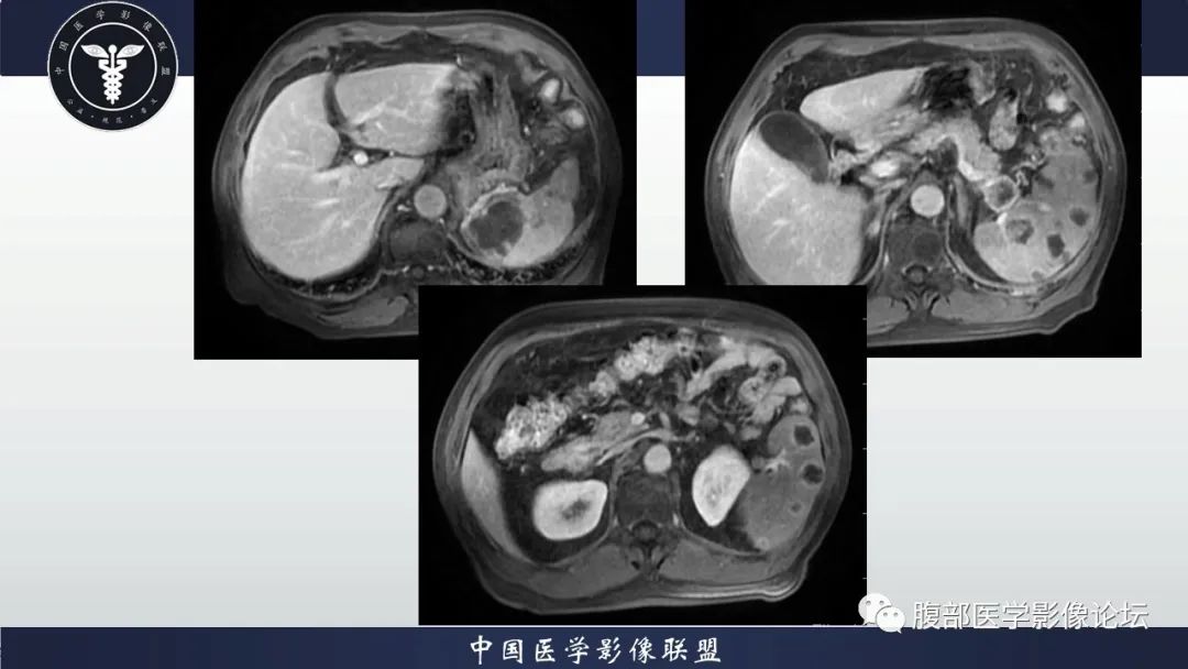 【病例】脾脏弥漫性大B细胞淋巴瘤1例MR影像讨论