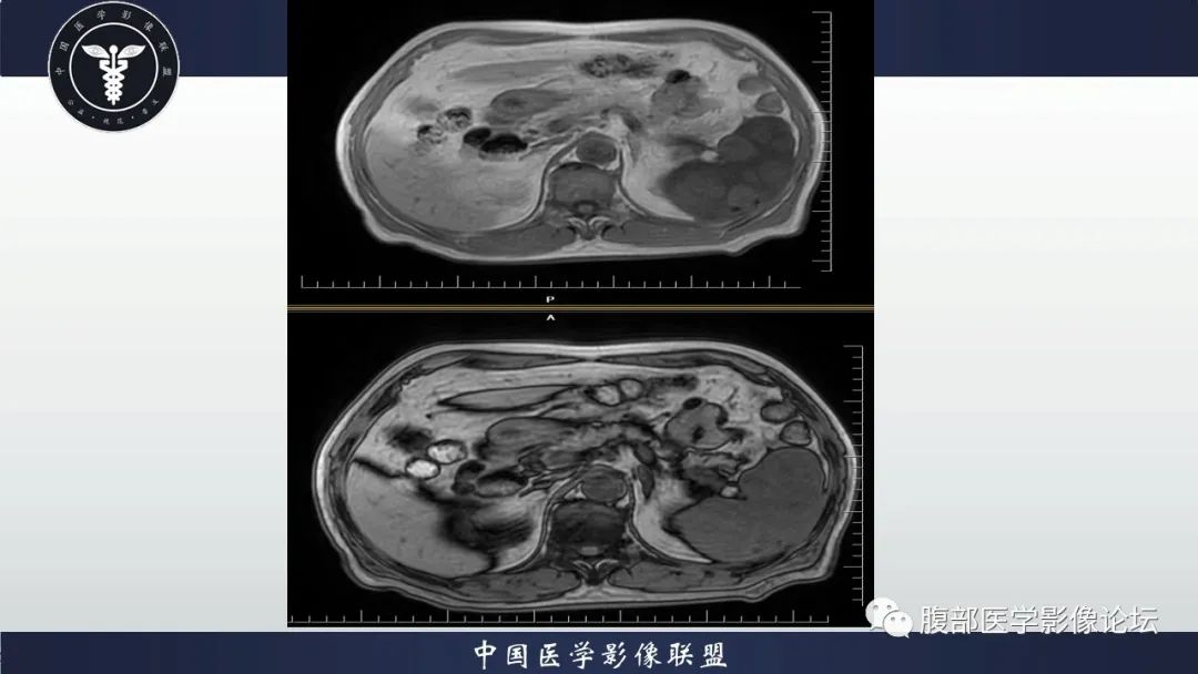 【病例】脾脏弥漫性大B细胞淋巴瘤1例MR影像讨论