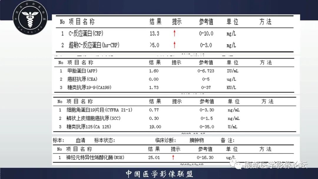 【病例】脾脏弥漫性大B细胞淋巴瘤1例MR影像讨论